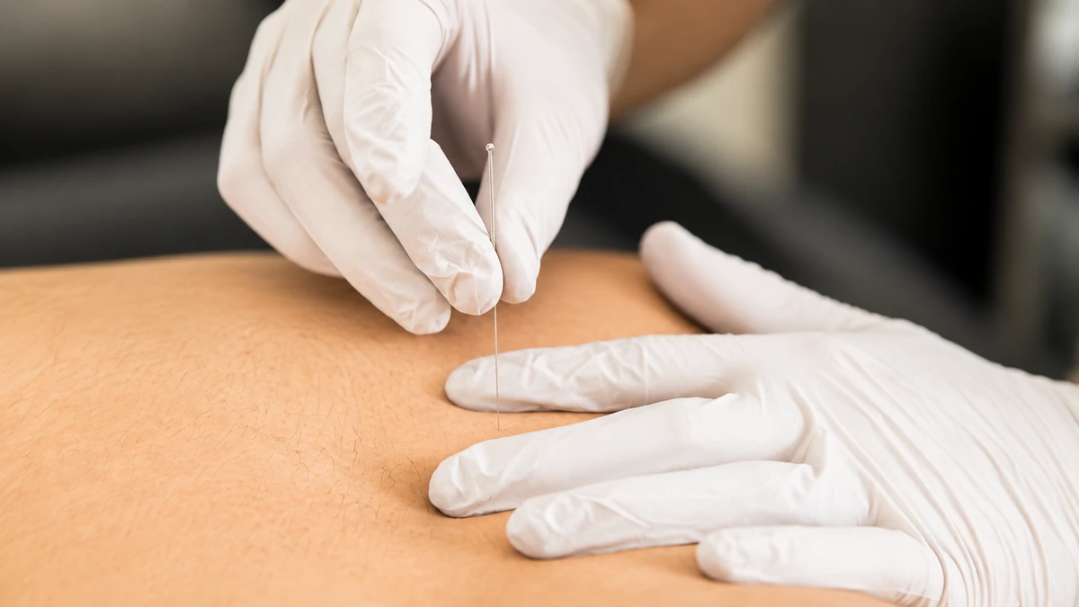 Dry Needling, Cupping & Taping